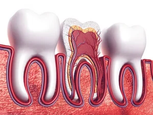What Is the Importance of Dental Endodontics?